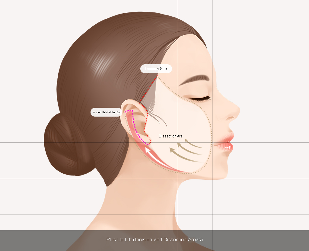 plus up lift process